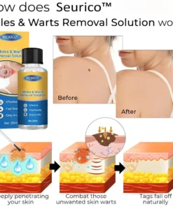 Seurico™ Moles & Warts Removal Solution