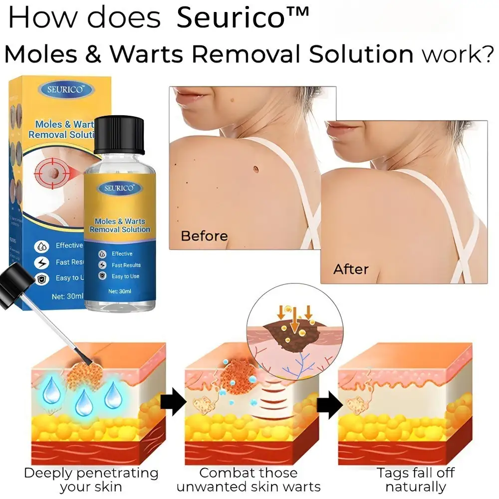 Seurico™ Moles & Warts Removal Solution