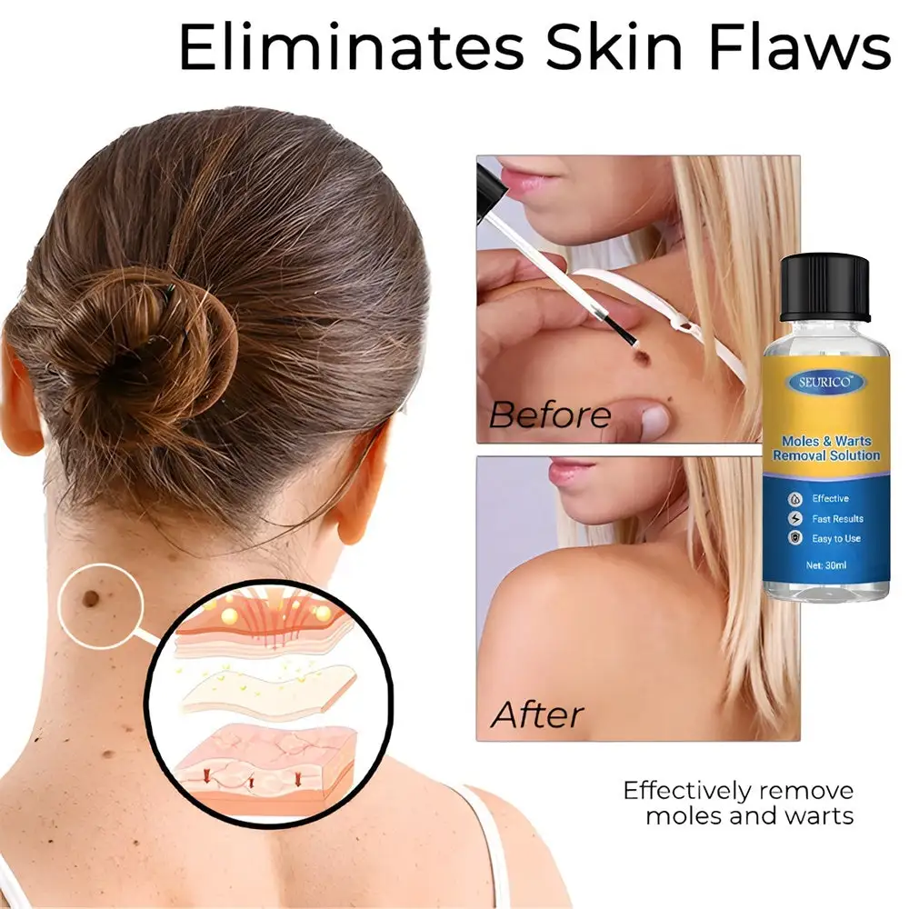 Seurico™ Moles & Warts Removal Solution