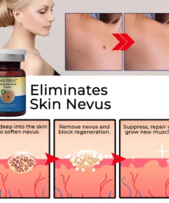 Seurico™ Nevus Removal Cream