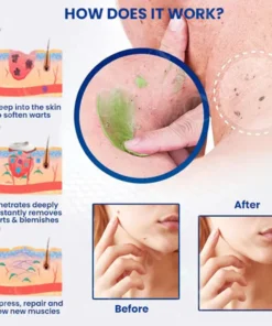 Seurico™ RapidErase Mole & Spot Cream