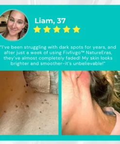 Seurico™ RapidErase Mole & Spot Cream