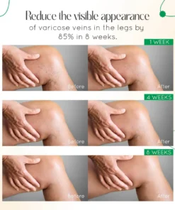 Seurico™ Varicose Vein Relief Cream