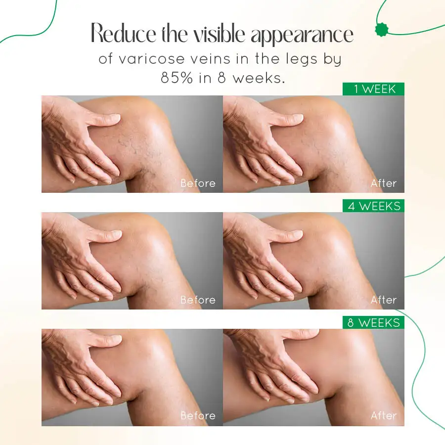 Seurico™ Varicose Vein Relief Cream