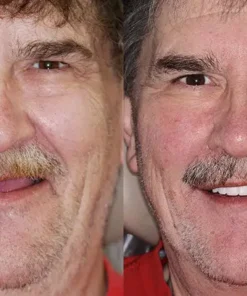 Seurico™ - Advanced Customized Full Denture Set