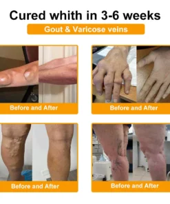 Seurico™ Botulinum Toxin & Bee Venom Pain-Relief Bone Healing Cream