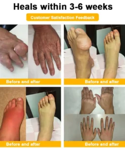 Seurico™ Botulinum Toxin & Bee Venom Pain-Relief Bone Healing Cream
