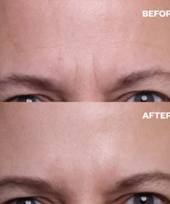 Seurico™ Forehead Wrinkle Patches