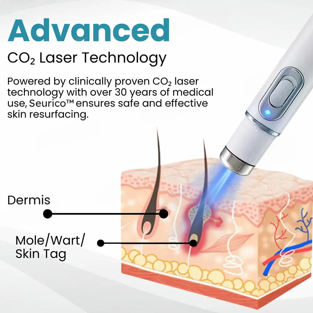 Seurico™ Laser Pen - Non-invasive Mole and Wart Removal
