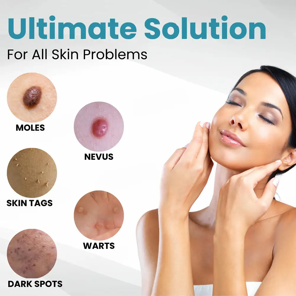 Seurico™ Laser Pen - Non-invasive Mole and Wart Removal