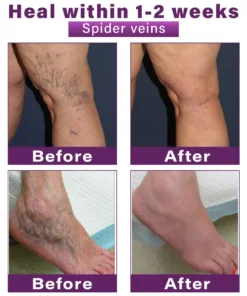 Seurico™ Polidocanol Nano Varicose Vein Patch
