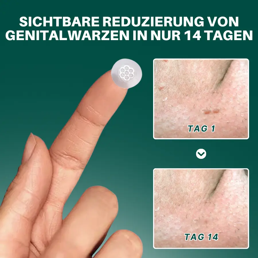 Seurico™ Magnesium Mikropin HPV Genitalien Warzen Entfernung Patch Pro
