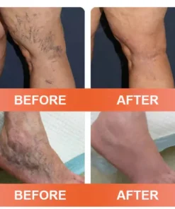 Seurico™ Vein Ease Microneedle Care Patch