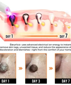 Seurico® All-in-One CO₂ Laser Eraser Pen